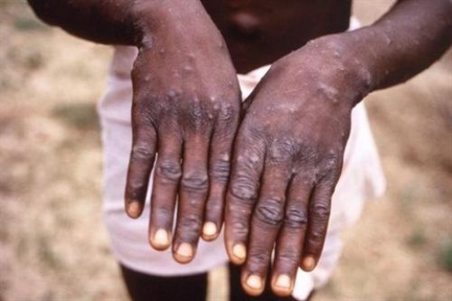 Yes, there is a monkeypox outbreak in Cameroon