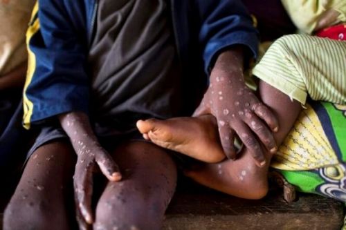 Mpox : l’épidémie qui sévit en RDC inquiète le Cameroun qui a déjà confirmé deux cas dont un décès