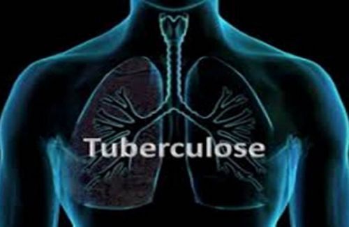 TB incidence dropped to 174/100,000 people  in Cameroon