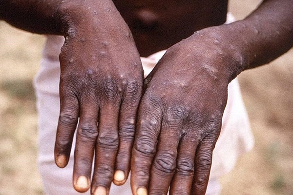 epidemie-de-variole-du-singe-deja-7-cas-detectes-dans-la-region-du-sud-ouest