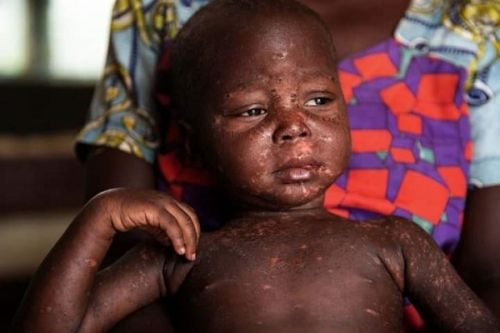 Cameroon reports an upsurge in measles cases