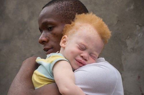 Les cheveux des albinos sont-ils mystiques ?