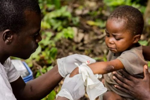 Alerte santé : la variole du singe repérée à Kumba au Sud-Ouest du Cameroun