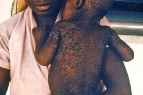 Sud : quatre cas de rougeole confirmés dans le district de santé de Meyomessala
